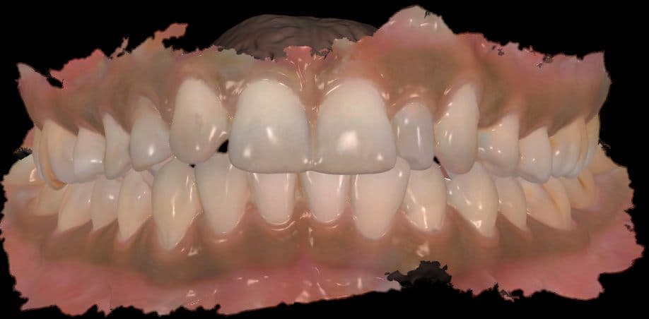 A digital scan of the upper and lower arches, showing the uneven widths and spacing of the front teeth before any treatment.