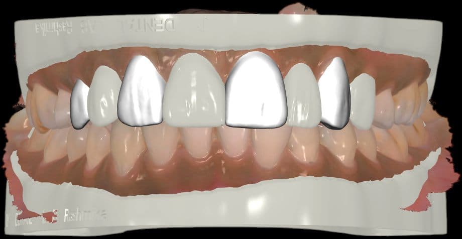 The digital design overlaid on the scan, the proposed new tooth shapes shown in white over the existing teeth.