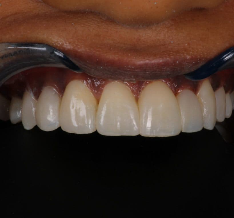 Close-up of the finished composite veneers, the biting edges characterised and the surfaces polished to a natural lustre.