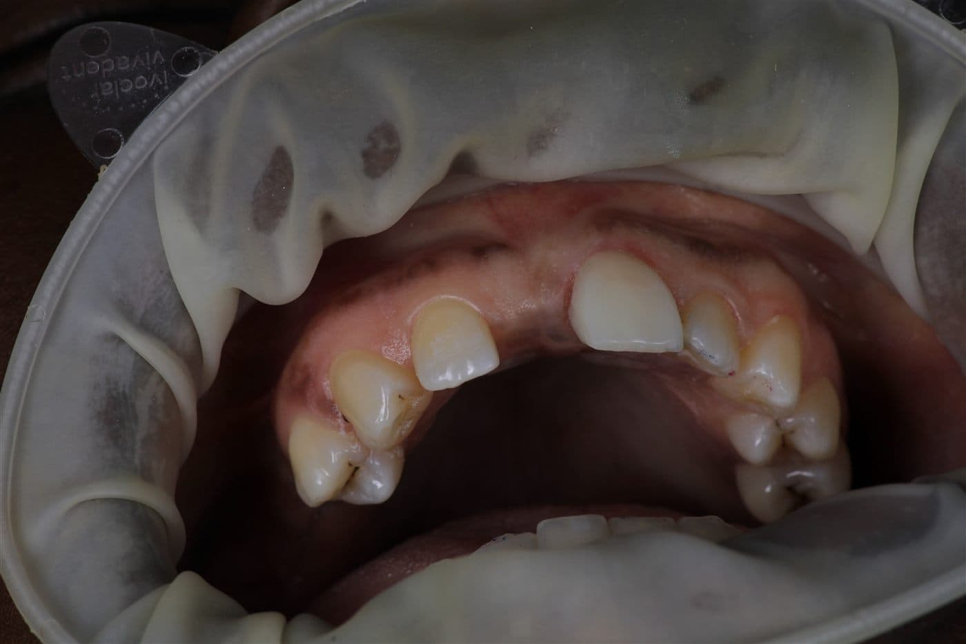Occlusal view of an upper arch under rubber dam isolation, showing the gap left by a missing lateral incisor and the healed ridge the replacement tooth will be shaped against.
