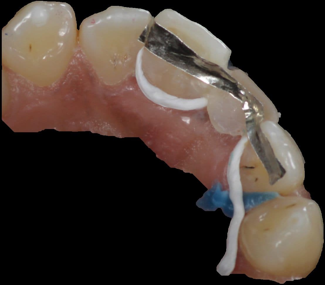Close-up of the woven Ribbond fibre being measured and adapted along the palatal surfaces of the teeth either side of the gap, held with an instrument before it is bonded.
