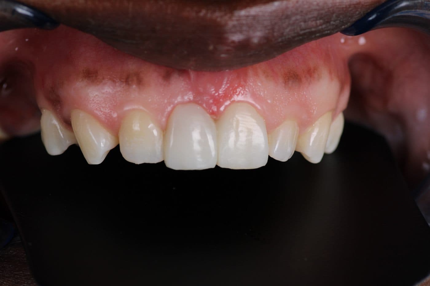 The finished fibre-reinforced bridge in place, the replacement front tooth matched in shape and shade to the natural teeth either side of it.