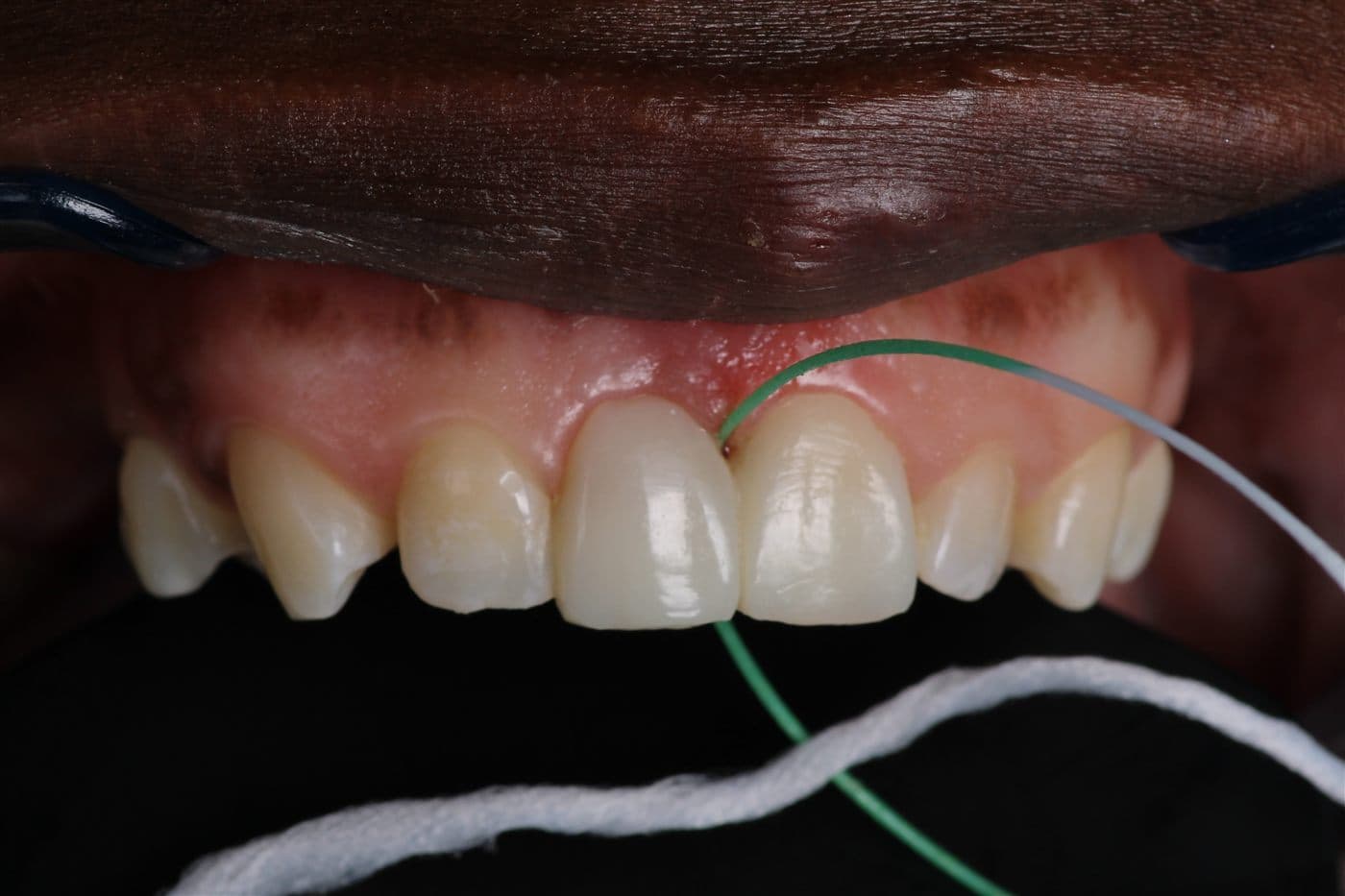 A floss threader being passed beneath the finished bridge in the chair, demonstrating to the patient how to clean under the replacement tooth.